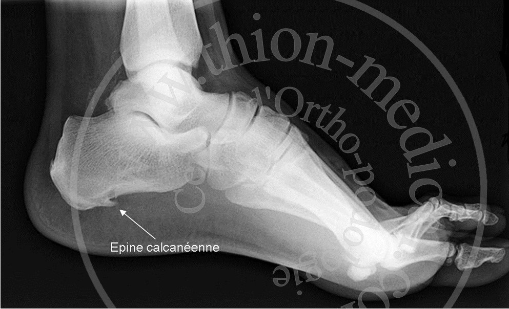 Radiographie de l’épine calcanéenne
